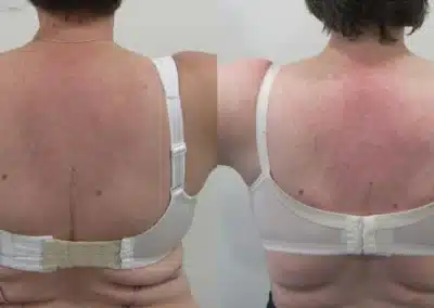 Venus Freeze Cellulite Reduction before and after photo by La Bella Laser & Slimming Inc. in Arcadia, CA
