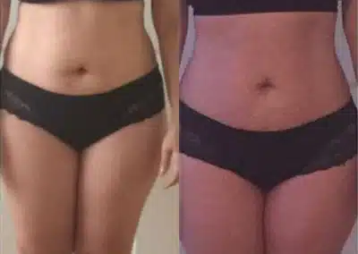 Venus Freeze Cellulite Reduction before and after photo by La Bella Laser & Slimming Inc. in Arcadia, CA