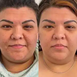 Derm Perfexion before and after photo by La Bella Laser & Slimming Inc. in Arcadia, CA