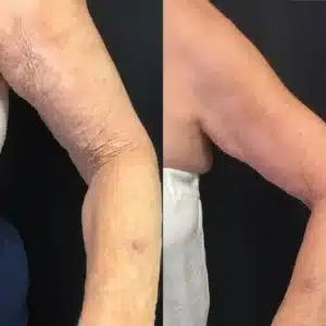 Derm Perfexion before and after photo by La Bella Laser & Slimming Inc. in Arcadia, CA