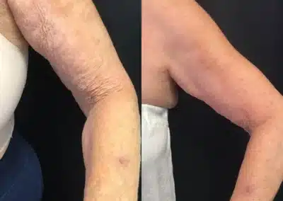 Derm Perfexion before and after photo by La Bella Laser & Slimming Inc. in Arcadia, CA