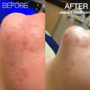 HydraFacial® MD before and after photo by La Bella Laser & Slimming Inc. in Arcadia, CA