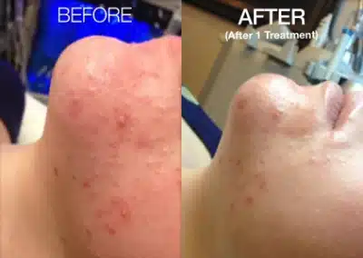 HydraFacial® MD before and after photo by La Bella Laser & Slimming Inc. in Arcadia, CA