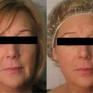 Venus Freeze™ Skin Tightening Facial before and after photo by La Bella Laser & Slimming Inc. in Arcadia, CA