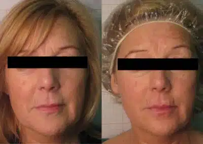 Venus Freeze™ Skin Tightening Facial before and after photo by La Bella Laser & Slimming Inc. in Arcadia, CA