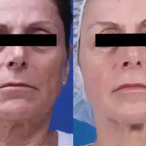 Venus Freeze™ Skin Tightening Facial before and after photo by La Bella Laser & Slimming Inc. in Arcadia, CA