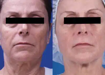 Venus Freeze™ Skin Tightening Facial before and after photo by La Bella Laser & Slimming Inc. in Arcadia, CA