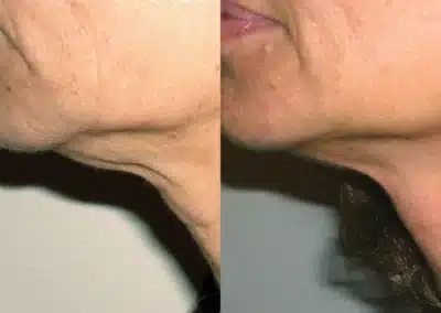 Venus Freeze™ Skin Tightening Facial before and after photo by La Bella Laser & Slimming Inc. in Arcadia, CA