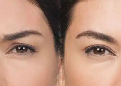 Botox before and after photo by La Bella Laser & Slimming Inc. in Arcadia, CA