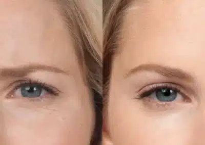Botox before and after photo by La Bella Laser & Slimming Inc. in Arcadia, CA