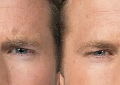 Botox before and after photo by La Bella Laser & Slimming Inc. in Arcadia, CA