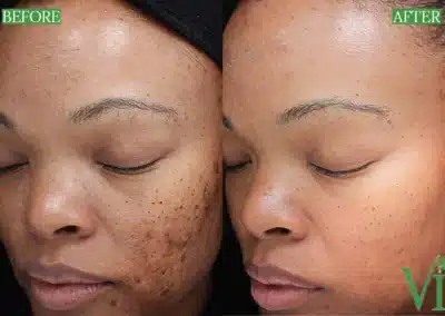 Chemical Peels before and after photo by La Bella Laser & Slimming Inc. in Arcadia, CA
