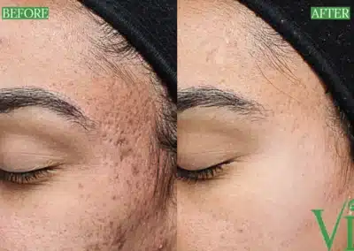 Chemical Peels before and after photo by La Bella Laser & Slimming Inc. in Arcadia, CA