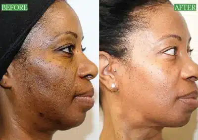 Chemical Peels before and after photo by La Bella Laser & Slimming Inc. in Arcadia, CA