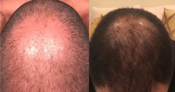 prp hair restoration before and after results