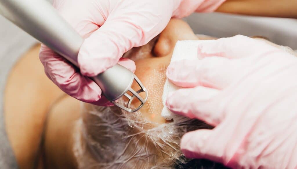 woman receiving co2 resurfacing treatment