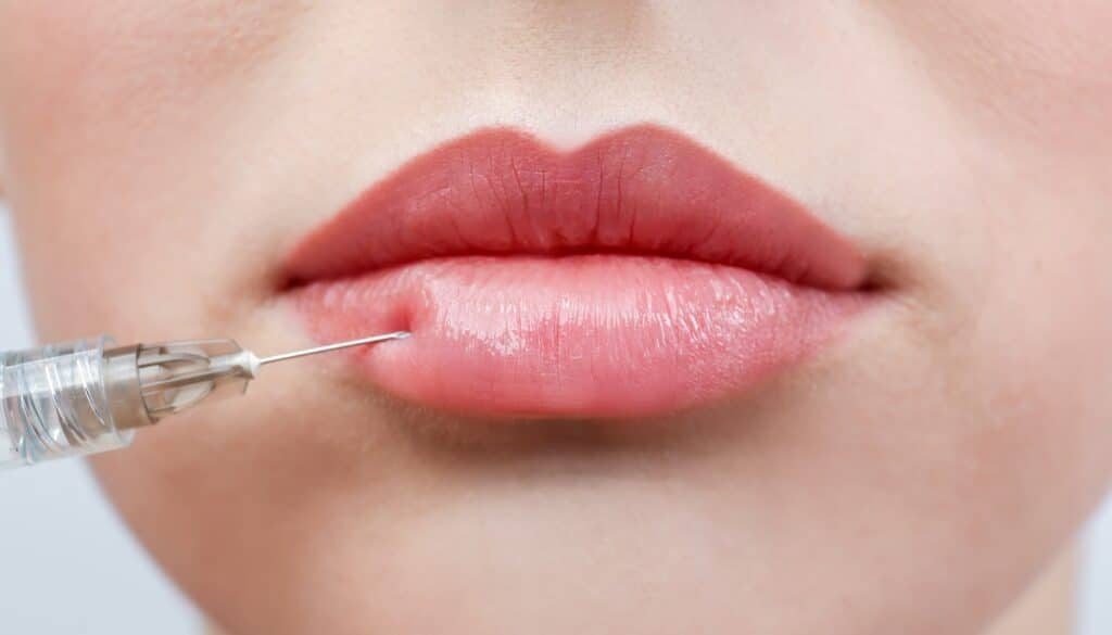 woman receiving volbella lip injection
