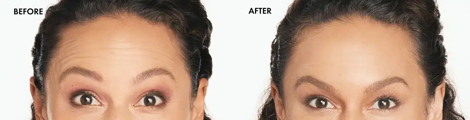 xeomin before and after photo by la bella laser slimming inc in arcadia ca